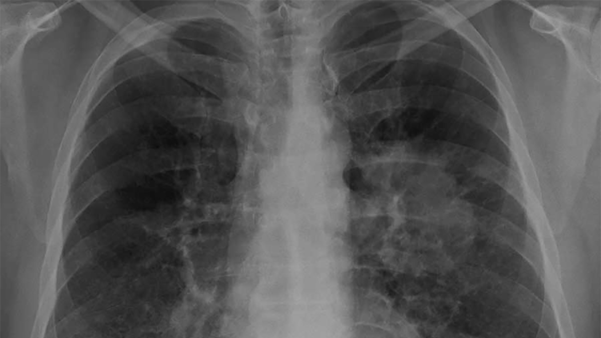 Lung cancer on a chest x-ray