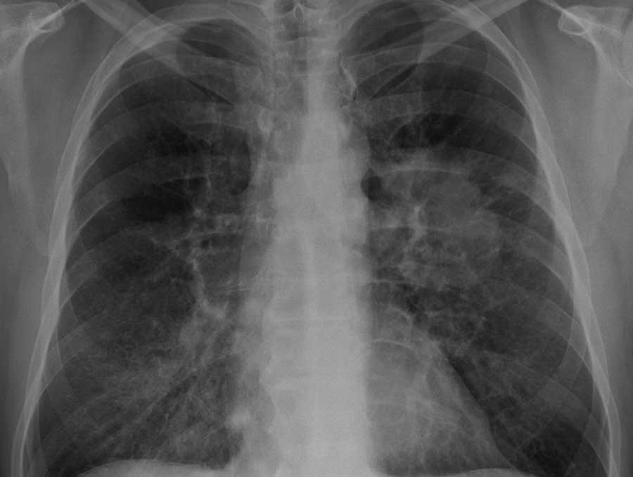 Lung cancer on a chest x-ray